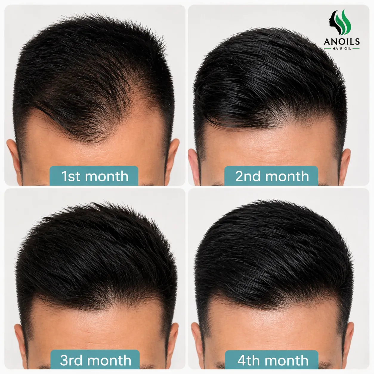 Herbal Hair Growth Oil – Anti Hair Fall